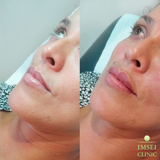 Negocio Imsei Clinic - Aesthetic And Regenerative ,Maspalomas, Playa Del Ingles ,Yumbo:Botox, Ácido Hialurónico, Peeling , Lipolaser